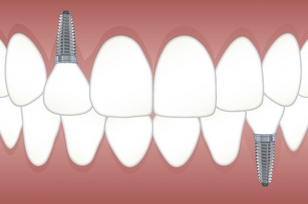 치아가 거의 남아 있지 않은 무치악 환자라면 임플란트 틀니가 대안이 될 수 있다. [사진=픽사베이]